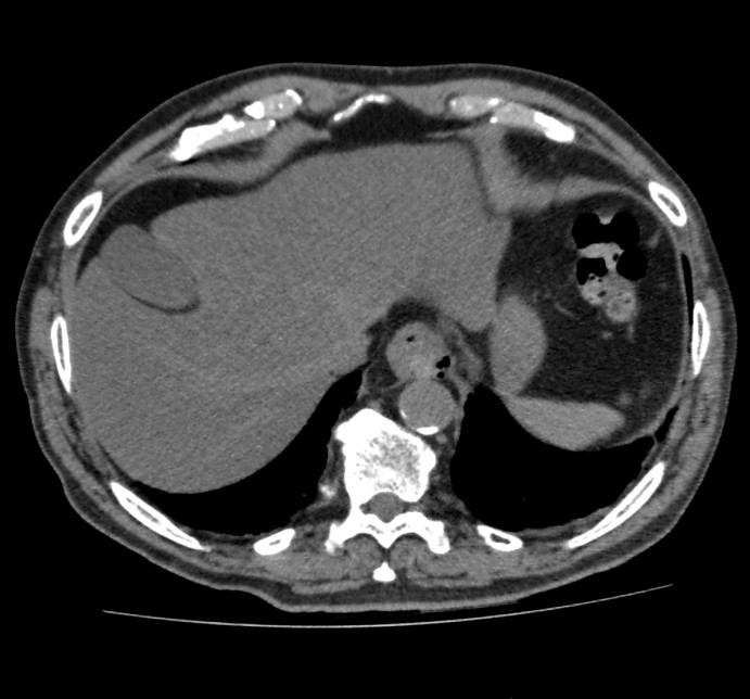 Síndrome de boerhaave