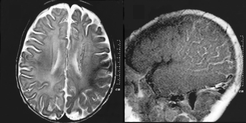 Síndrome de Sturge Weber