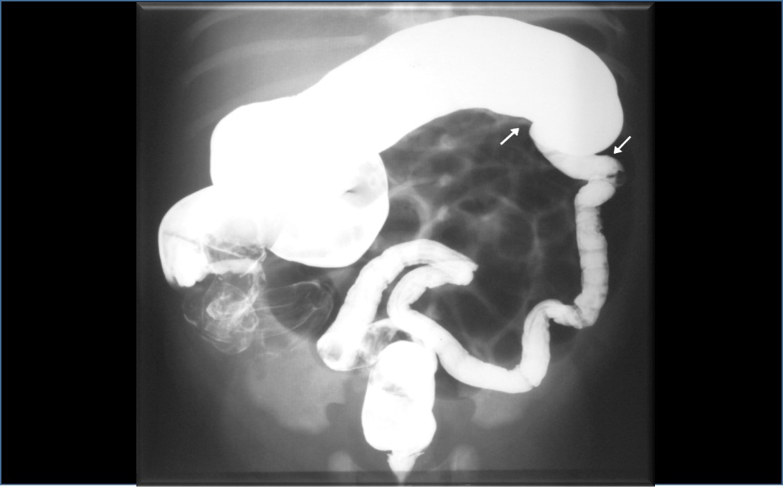 Síndrome do cólon esquerdo pequeno