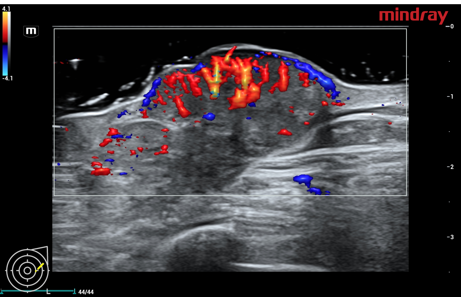 Skin involvement of breast cancer