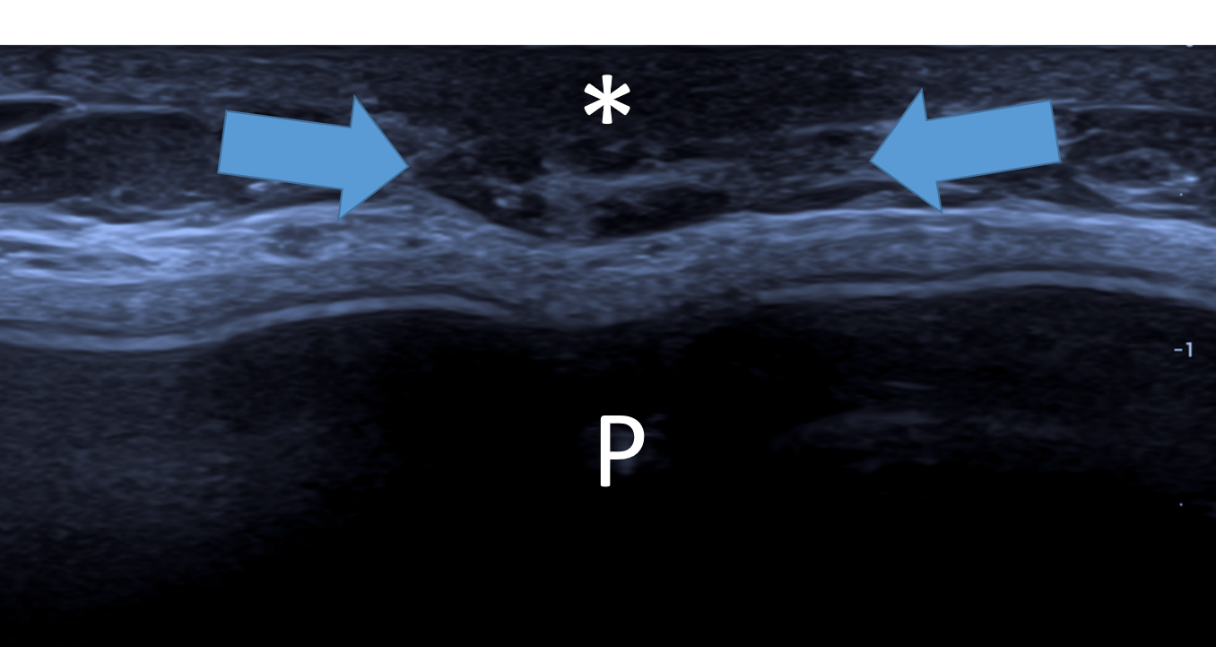 parenquima_pos_adenomastec