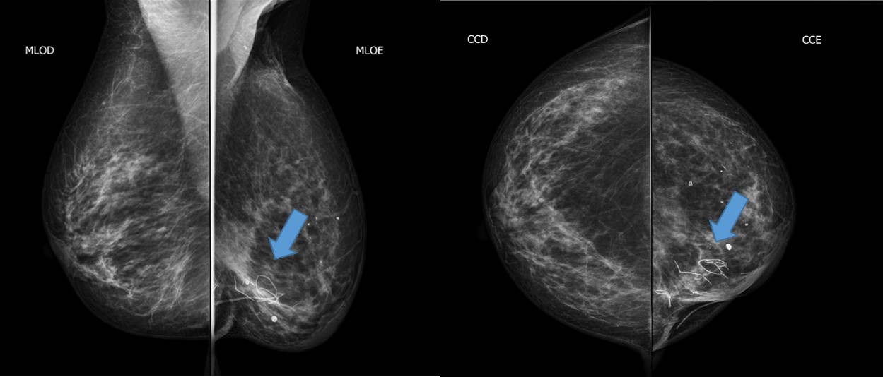 Sutere calcifications