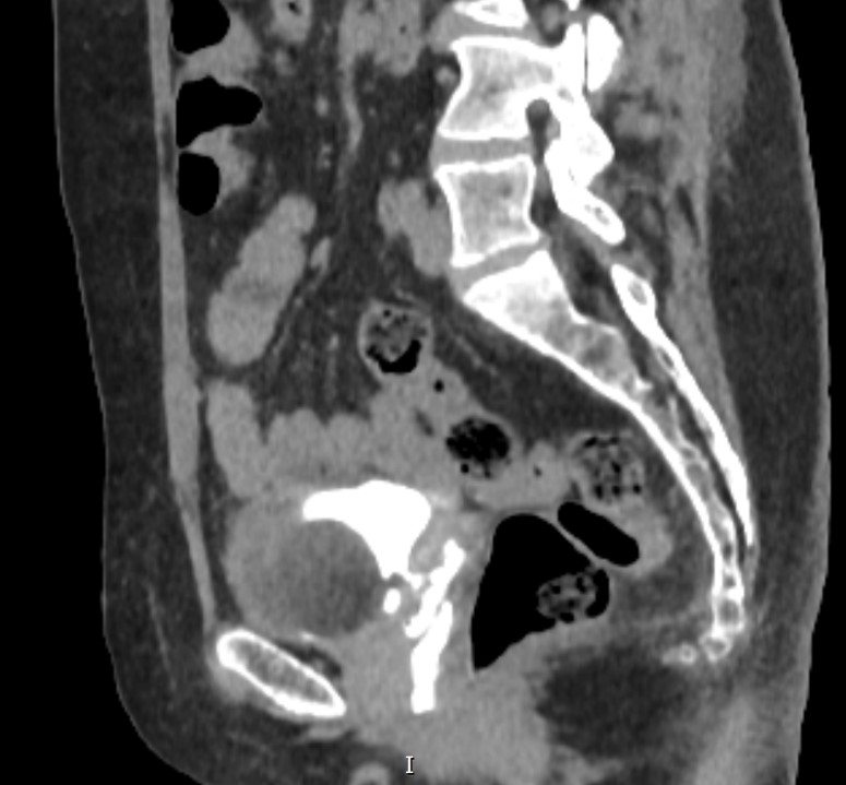 Tomografia com fístula vésico vaginal