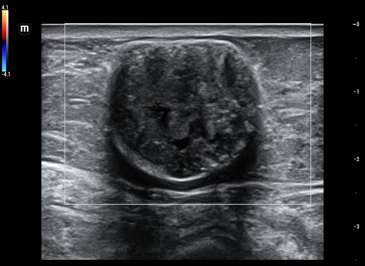 Ultrasound of lipotransfer in breast reconstruction after breast cancer