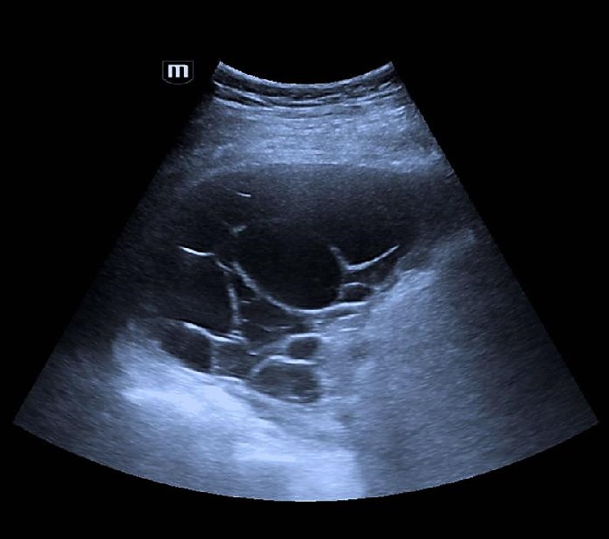 Ultrassom de tórax com derrame pleural multiloculado
