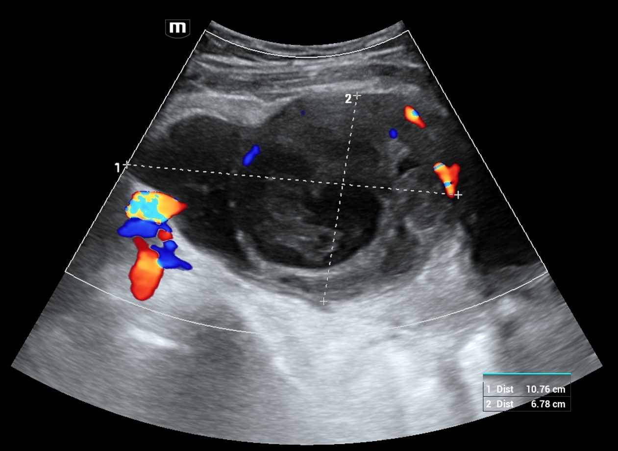 Ultrassonografia de abscesso tubo ovariano