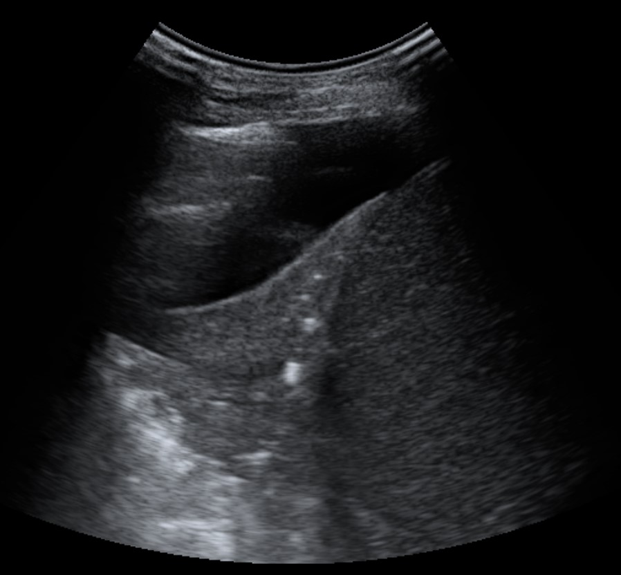 Ultrassonografia na complementação do raio-x de tórax com suspeita de derrame pleural